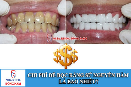 chi phí để bọc răng sứ nguyên hàm là bao nhiêu