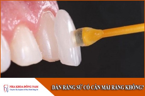 dán răng sứ có cần mài răng không