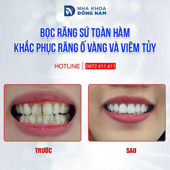 Điều trị tủy đúng kỹ thuật giúp bảo vệ răng tốt hơn