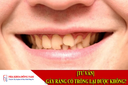 gãy răng có trồng lại được không