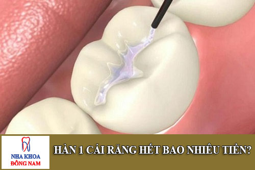 hàn 1 cái răng hết bao nhiêu tiền