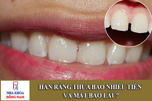 hàn răng thưa bao nhiêu tiền và mất bao lâu