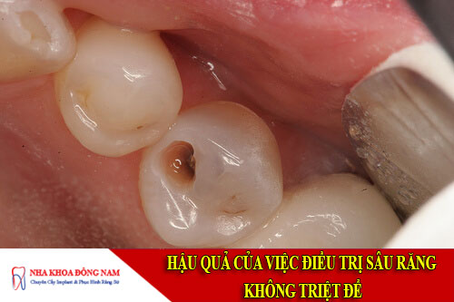 hậu quả của việc điều trị sâu răng không triệt để