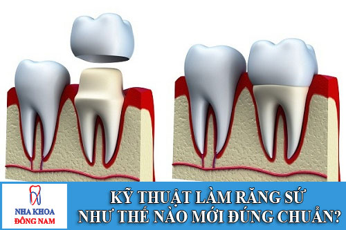 kỹ thuật làm răng sứ như thế nào mới đúng chuẩn