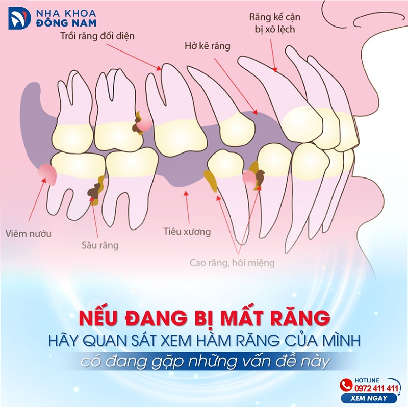 Mất răng hàm gây ra nhiều hậu quả nghiêm trọng