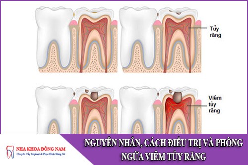 nguyên nhân cách điều trị và phòng ngừa viêm tủy răng