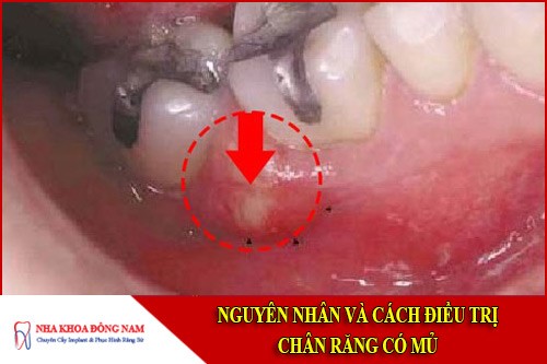 nguyên nhân và cách điều trị chân răng có mủ