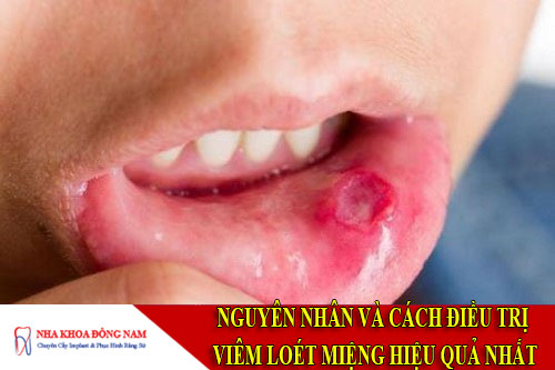 nguyên nhân và cách điều trị viêm loét miệng hiệu quả nhất