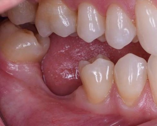tiêu xương hàm do mất răng