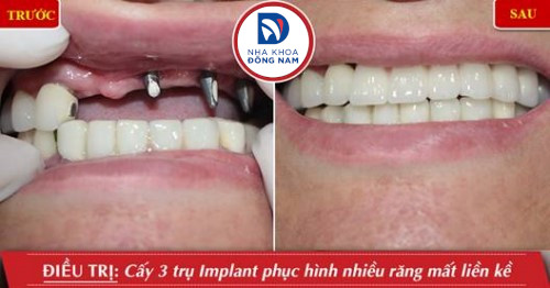 cấy ghép implant hàm trên