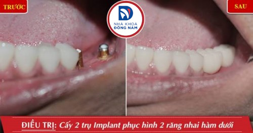 trồng 2 trụ implant răng nhai