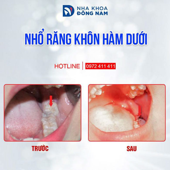 Nhổ răng khôn mọc lệch sớm để tránh biến chứng nguy hiểm