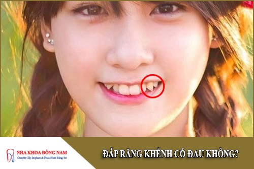 đắp răng khểnh có đau không