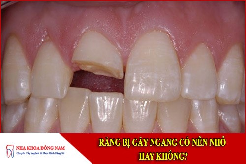 răng bị gãy ngang có nên nhổ hay không