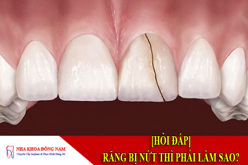 răng bị nứt thì phải làm sao