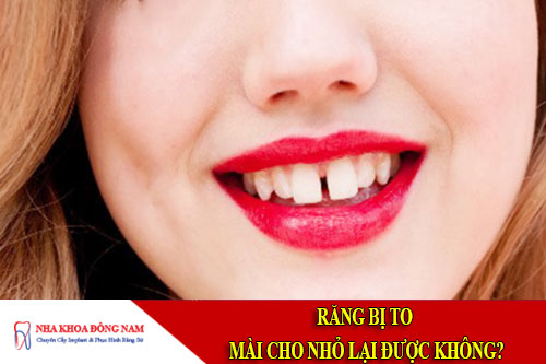 răng bị to, mài cho nhỏ lại được không