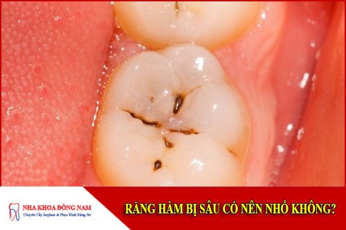 răng hàm bị sâu có nên nhổ không