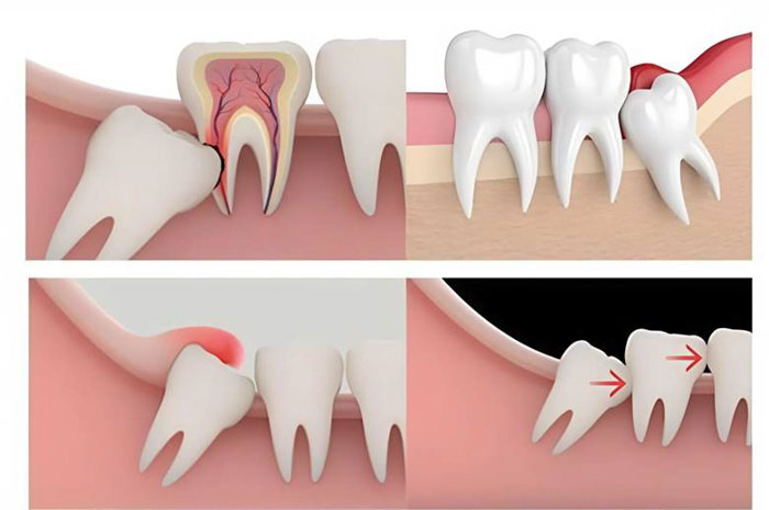 Răng khôn mọc lệch là nguyên nhân hàng đầu gây đau răng trong cùng