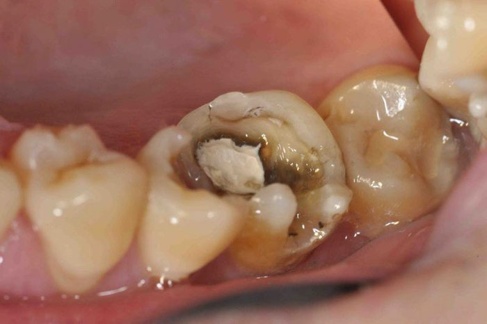 Răng sâu nặng cần tiến hành chữa tủy để giữ răng