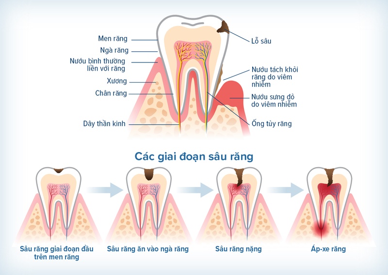 Sâu răng thường tiến triển qua 4 giai đoạn