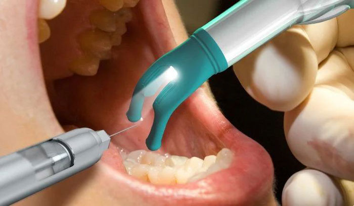 Tiêm thuốc tê vào vị trí chiếc răng cần chữa tủy