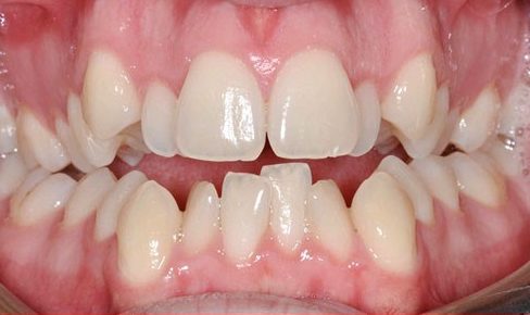 bật mí cách điều trị hàm răng khấp khểnh của bác sĩ 1