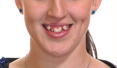 bật mí cách điều trị hàm răng khấp khểnh của bác sĩ 2