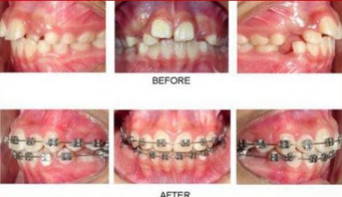 bật mí cách điều trị hàm răng khấp khểnh của bác sĩ 3