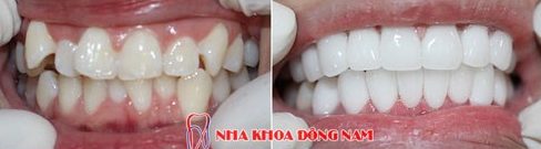 bật mí cách điều trị hàm răng khấp khểnh của bác sĩ 5