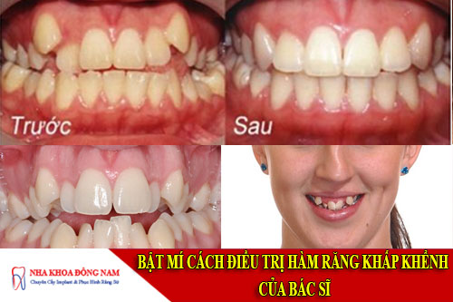 bật mí cách điều trị hàm răng khấp khểnh của bác sĩ