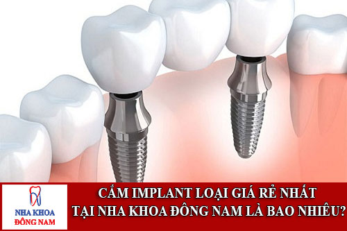 cắm implant loại giá rẻ nhất tại nha khoa đông nam là bao nhiêu