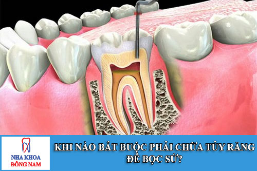 khi nào bắt buộc phải chữa tủy răng để bọc sứ