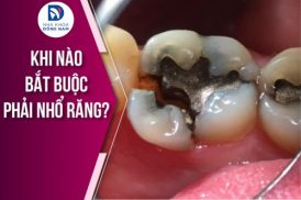 Khi Nào Bắt Buộc Phải Nhổ Răng