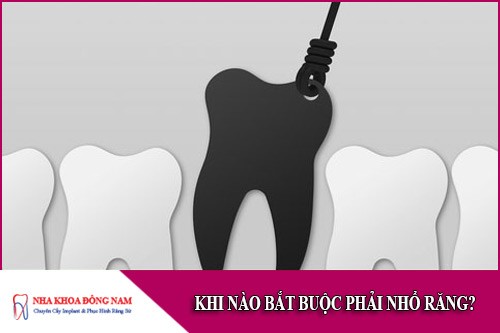 khi nào bắt buộc phải nhổ răng