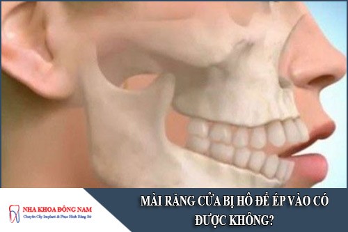 mài răng cửa bị hô để ép vào có được không