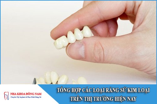 tổng hợp các loại răng sứ kim loại trên thị trường hiện nay