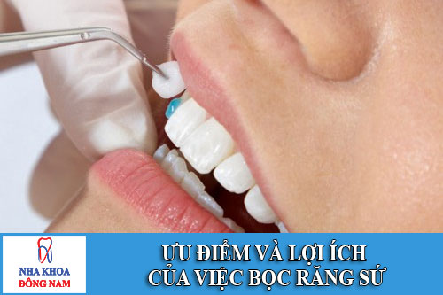 ưu điểm và lợi ích của việc bọc răng sứ