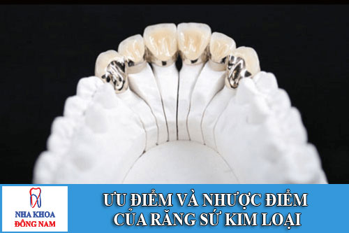 ưu điểm và nhược điểm của răng sứ kim loại