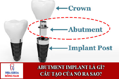 abutment implant là gì? cấu tạo của nó ra sao?