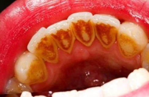 Cạo vôi răng có sử dụng Bảo Hiểm Y Tế được không 1