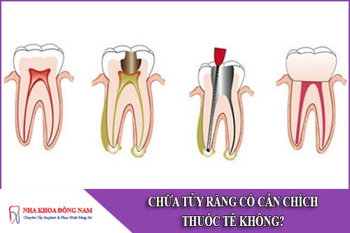 chữa tủy răng có cần chích thuốc tê không