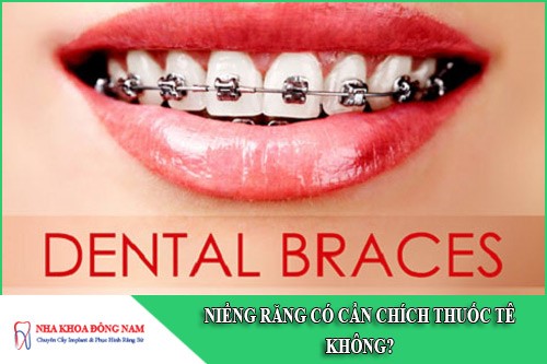 niềng răng có cần chích thuốc tê không