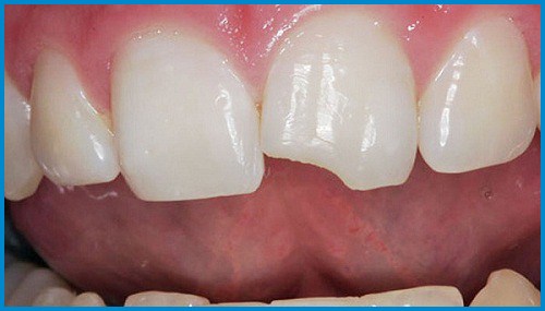 so sánh độ cứng của răng sứ với răng thật 2