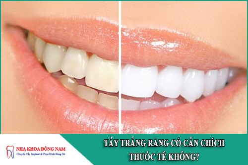 tẩy trắng răng có cần chích thuốc tê không