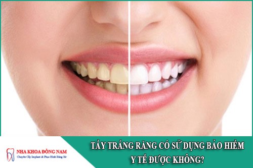 tẩy trắng răng có sử dụng bảo hiểm y tế được không