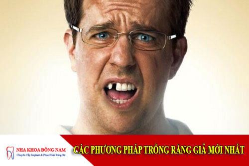 Các phương pháp trồng răng giả mới nhất