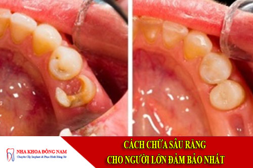 cách chữa sâu răng cho người lớn đảm bảo nhất