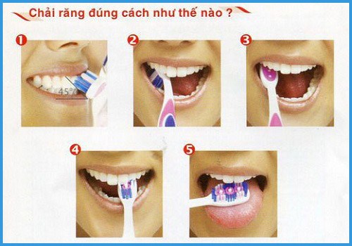Cách vệ sinh răng sứ theo lời khuyên của nha sĩ 1