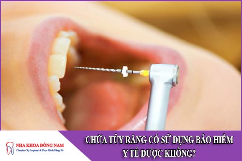 chữa tủy răng có sử dụng được bảo hiểm y tế không