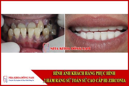 Hình ảnh khách hàng phục hình răng toàn sứ Hi-Zirconia